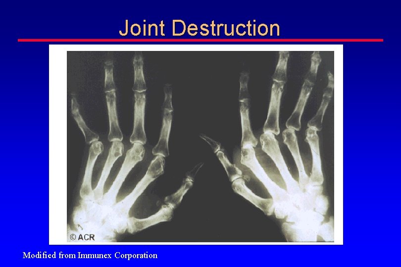 Joint Destruction Modified from Immunex Corporation 
