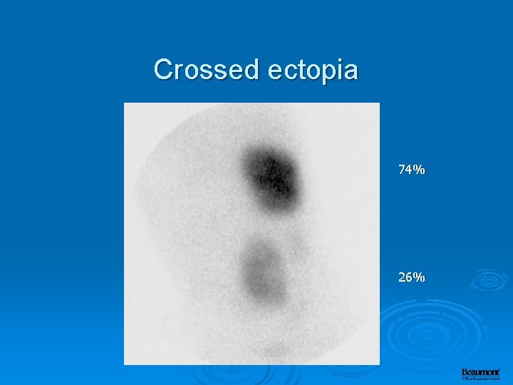 Crossed ectopia 74% 26% 