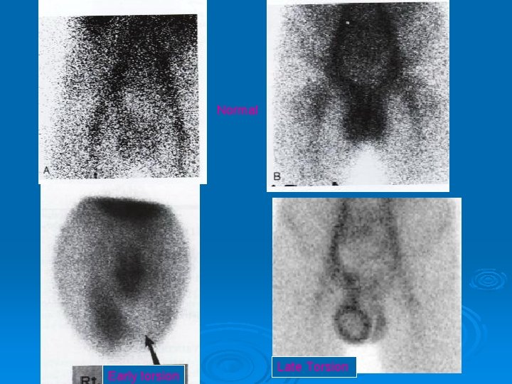 Normal Early torsion Late Torsion 