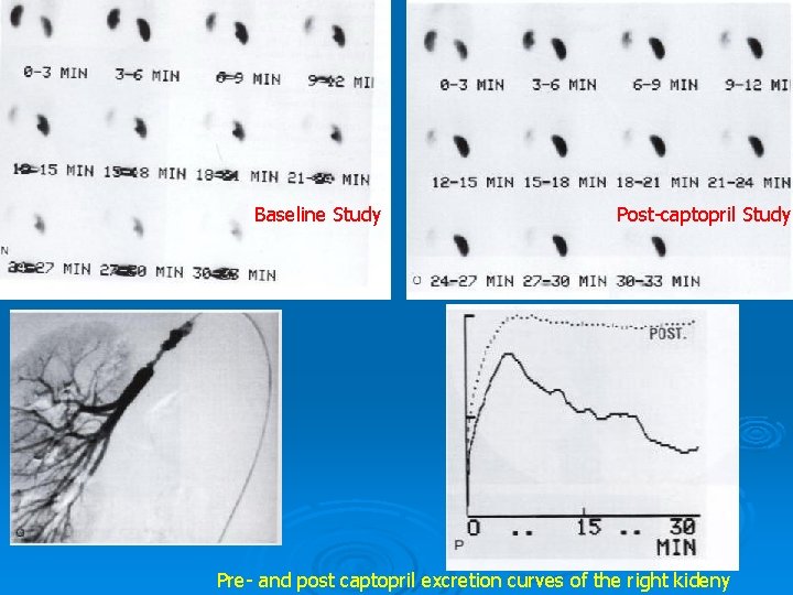 Baseline Study Post-captopril Study Pre- and post captopril excretion curves of the right kideny