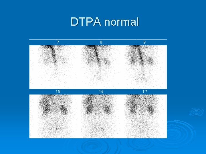 DTPA normal 