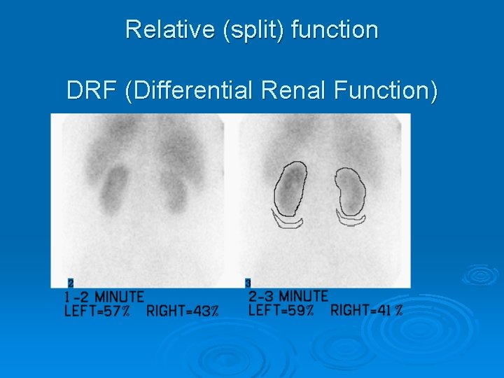 Relative (split) function DRF (Differential Renal Function) 