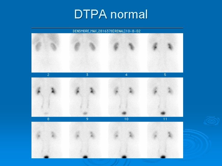 DTPA normal 