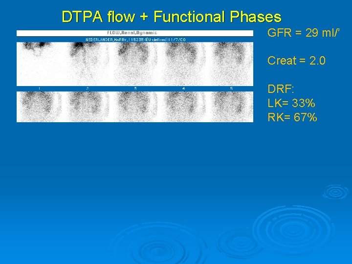 DTPA flow + Functional Phases GFR = 29 ml/’ Creat = 2. 0 DRF: