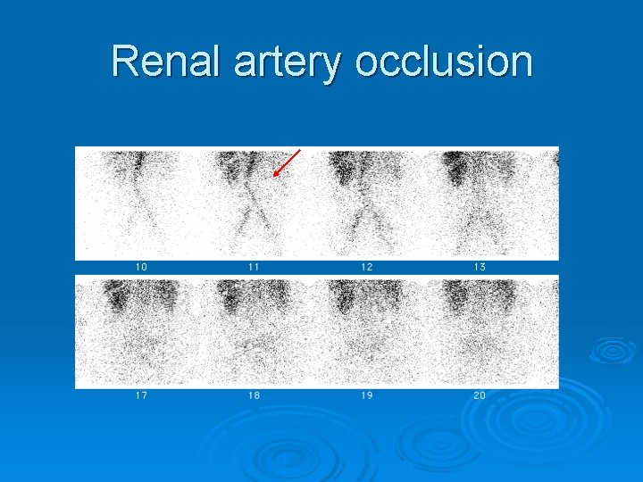 Renal artery occlusion 