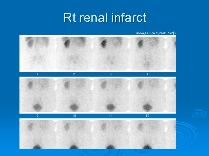 Rt renal infarct 