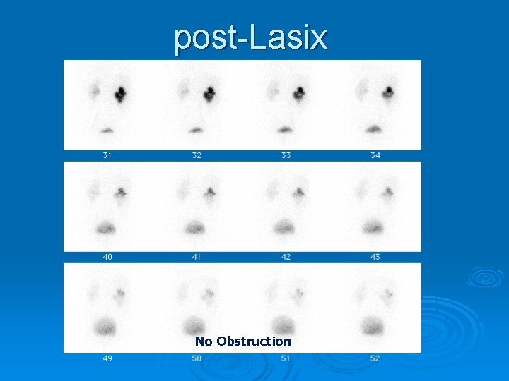 post-Lasix No Obstruction 