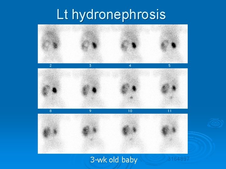 Lt hydronephrosis 3 -wk old baby 3164897 