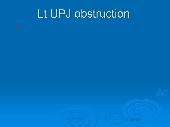 Lt UPJ obstruction 3164897 