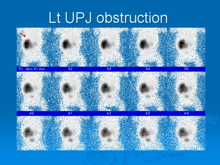 Lt UPJ obstruction 3164897 