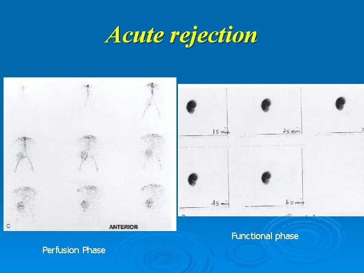 Acute rejection Functional phase Perfusion Phase 