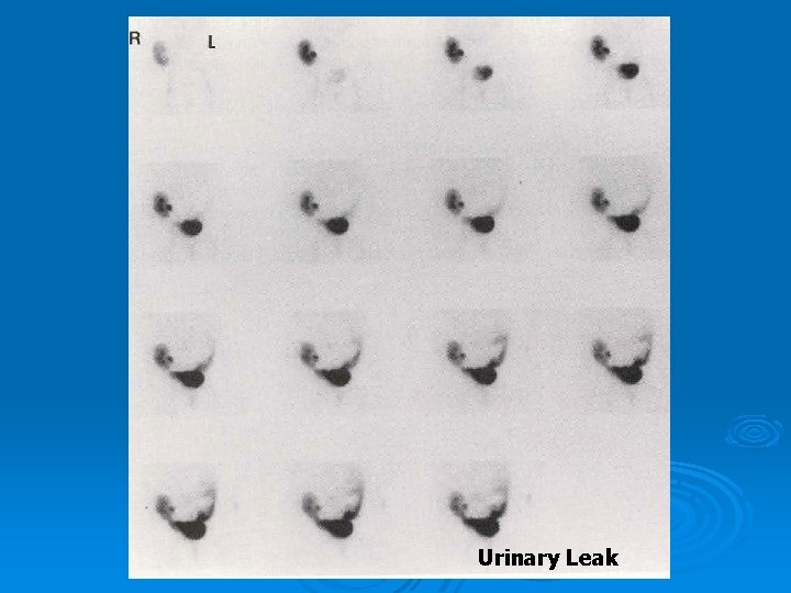 Urinary Leak 