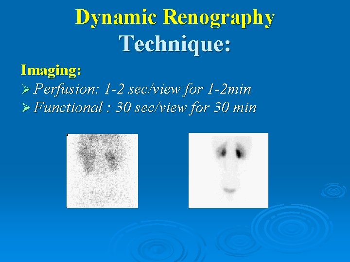 Dynamic Renography Technique: Imaging: Ø Perfusion: 1 -2 sec/view for 1 -2 min Ø