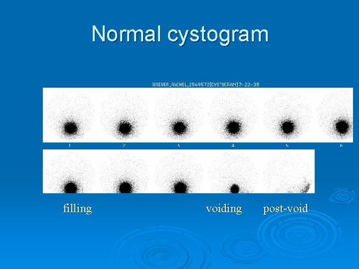 Normal cystogram filling voiding post-void 