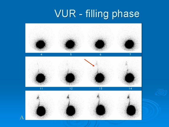 VUR - filling phase A 
