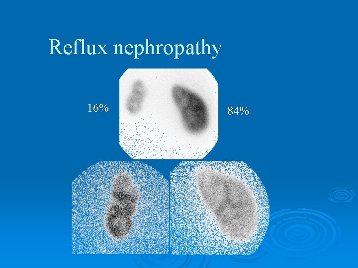 Reflux nephropathy 16% 84% 