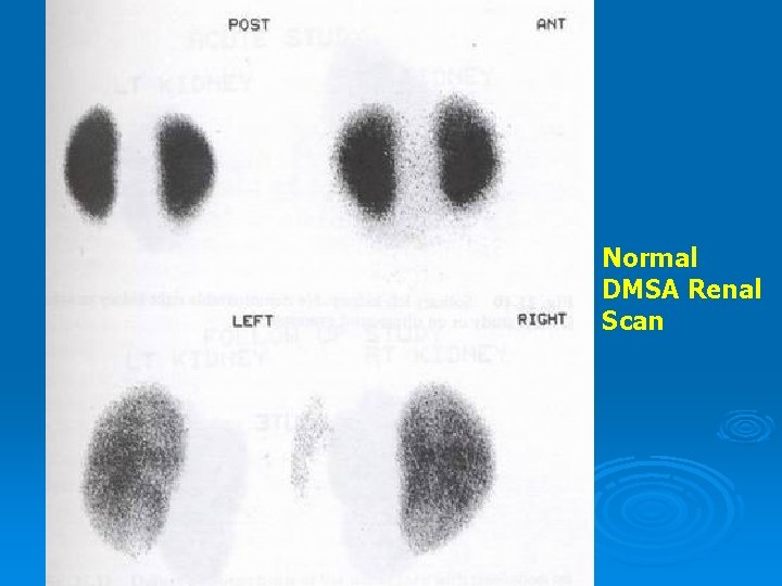 Normal DMSA Renal Scan 
