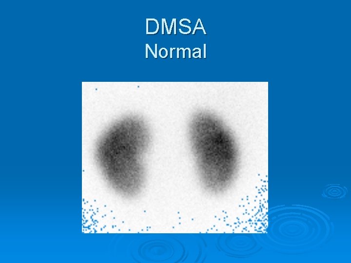DMSA Normal 