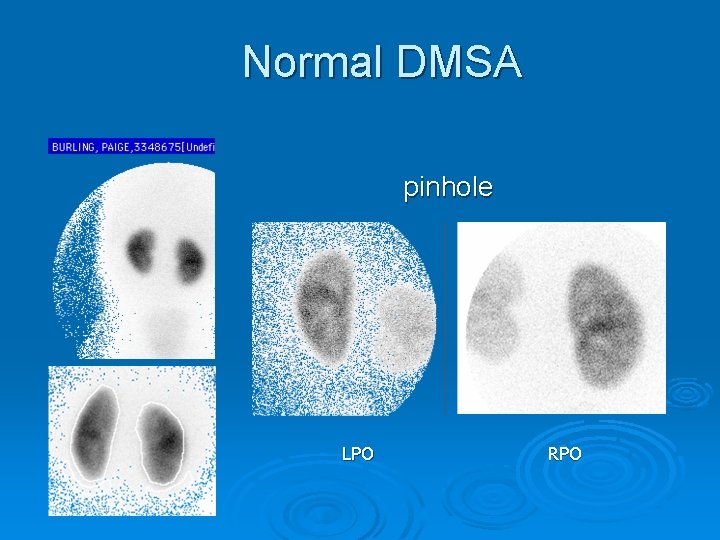 Normal DMSA pinhole LPO RPO 