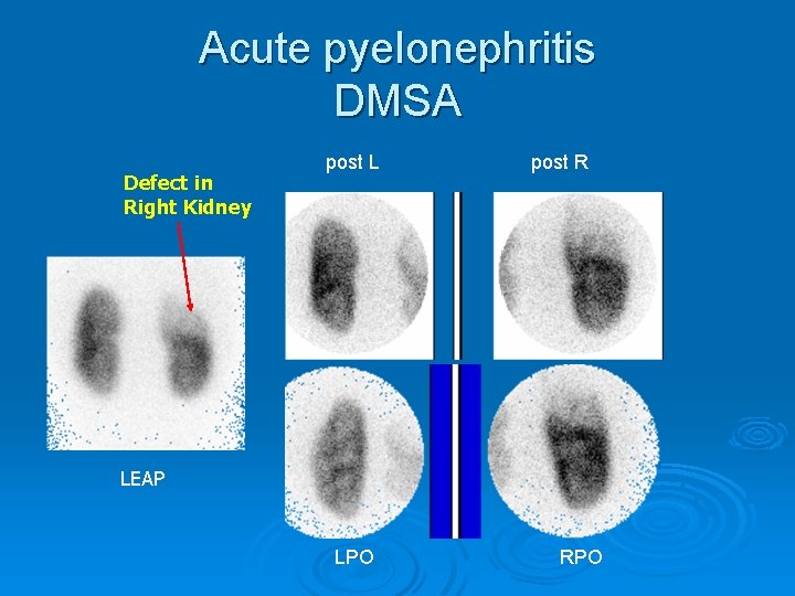 Acute pyelonephritis DMSA Defect in Right Kidney post L post R LEAP LPO RPO