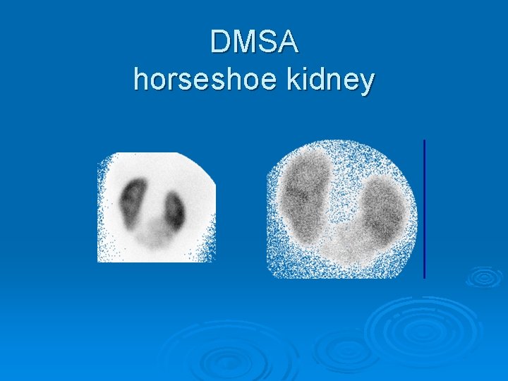 DMSA horseshoe kidney 