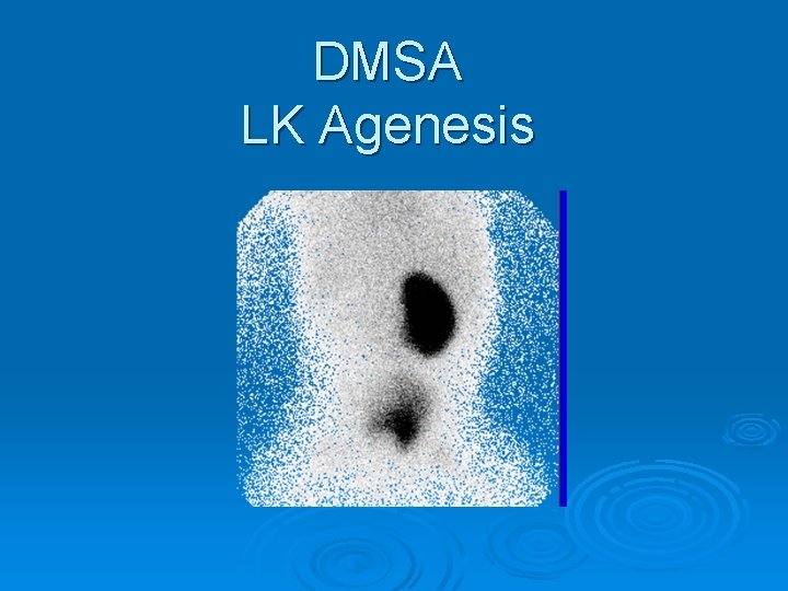 DMSA LK Agenesis 