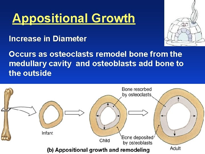 Appositional Growth Increase in Diameter Occurs as osteoclasts remodel bone from the medullary cavity