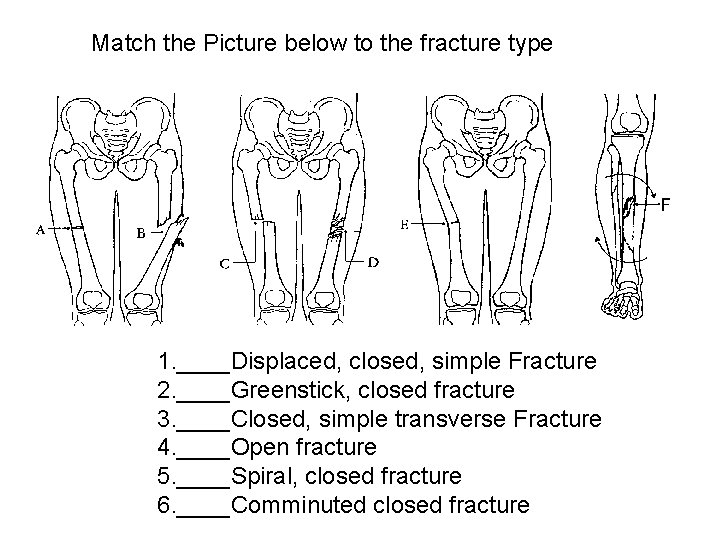 Match the Picture below to the fracture type AP view 1. ____Displaced, closed, simple