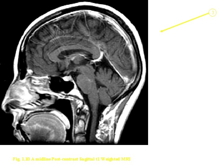 3 Fig. 1. 10 A midline Post-contrast Sagittal t 1 Weighted MRI 