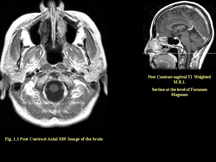 Post Contrast sagittal T 1 Weighted M. R. I. Section at the level of