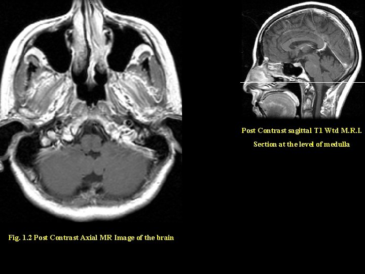 Post Contrast sagittal T 1 Wtd M. R. I. Section at the level of