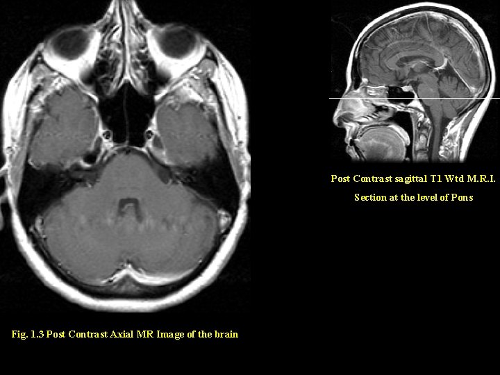 Post Contrast sagittal T 1 Wtd M. R. I. Section at the level of