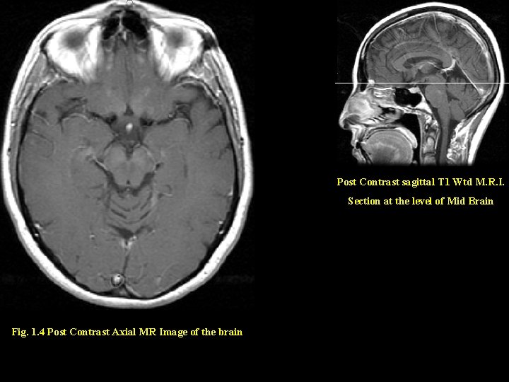 Post Contrast sagittal T 1 Wtd M. R. I. Section at the level of