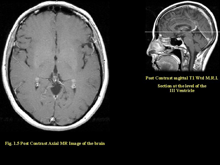 Post Contrast sagittal T 1 Wtd M. R. I. Section at the level of