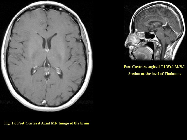 Post Contrast sagittal T 1 Wtd M. R. I. Section at the level of