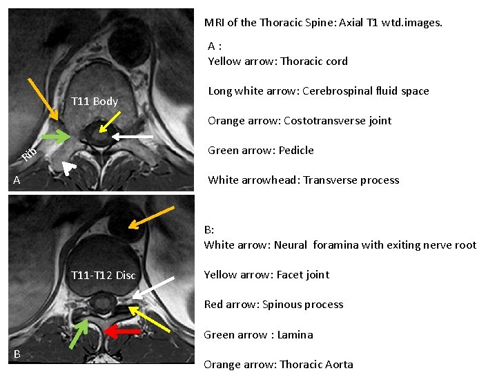 MRI of the Thoracic Spine: Axial T 1 wtd. images. A: Yellow arrow: Thoracic