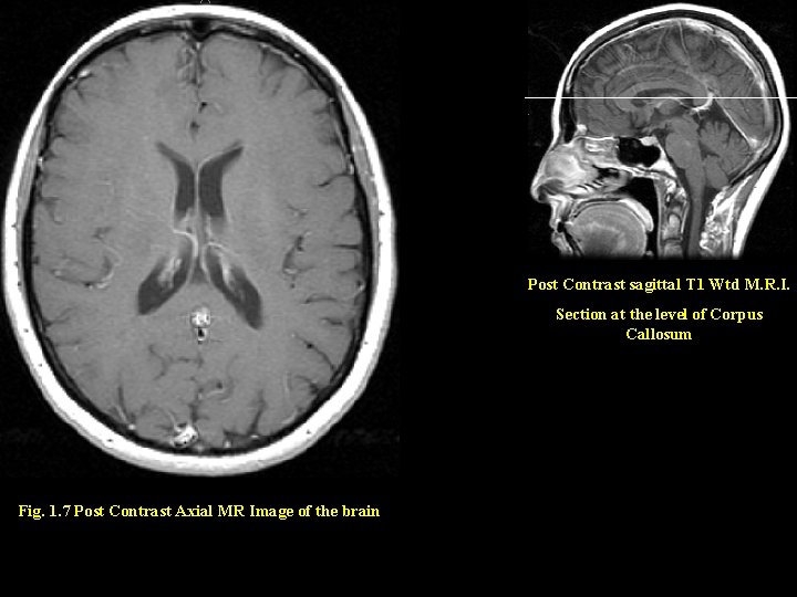 Post Contrast sagittal T 1 Wtd M. R. I. Section at the level of