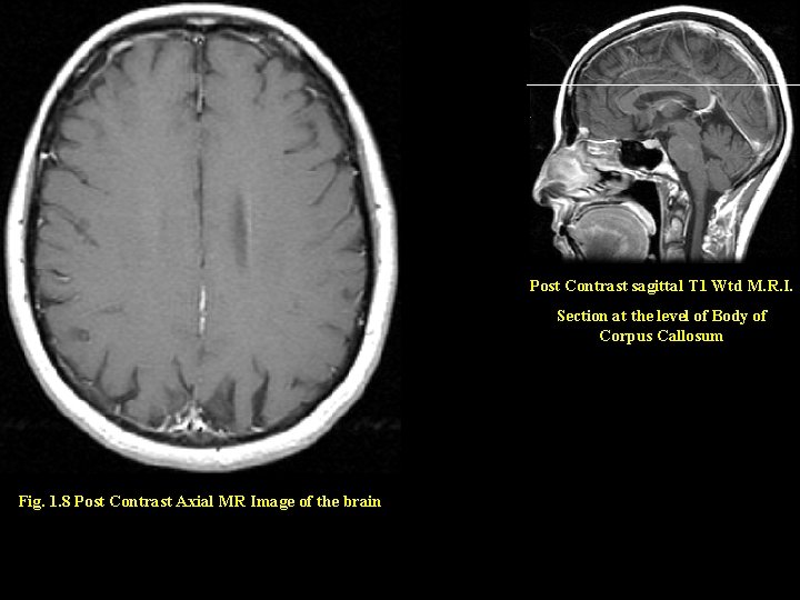 Post Contrast sagittal T 1 Wtd M. R. I. Section at the level of