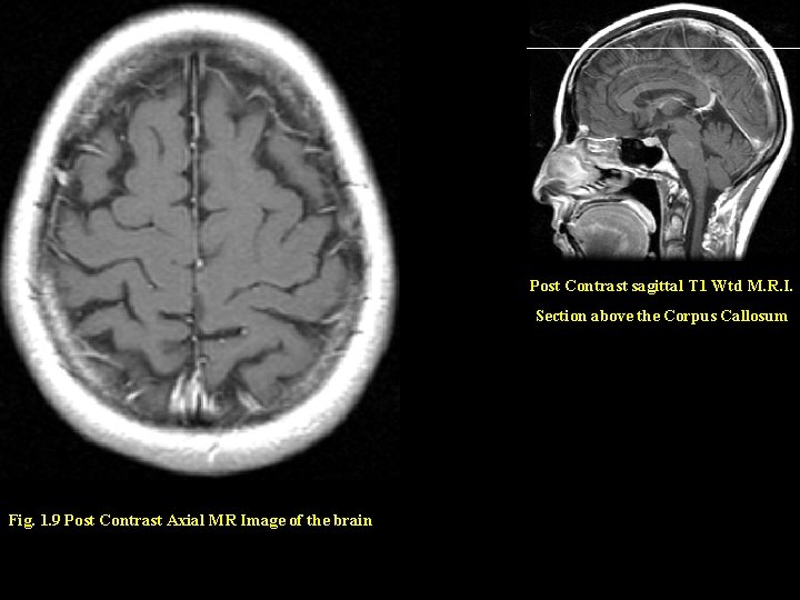 Post Contrast sagittal T 1 Wtd M. R. I. Section above the Corpus Callosum Post Contrast sagittal T 1 Wtd M. R. I. Section above the Corpus Callosum