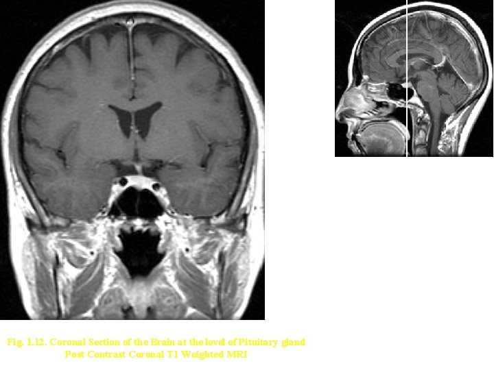 Fig. 1. 12. Coronal Section of the Brain at the level of Pituitary gland