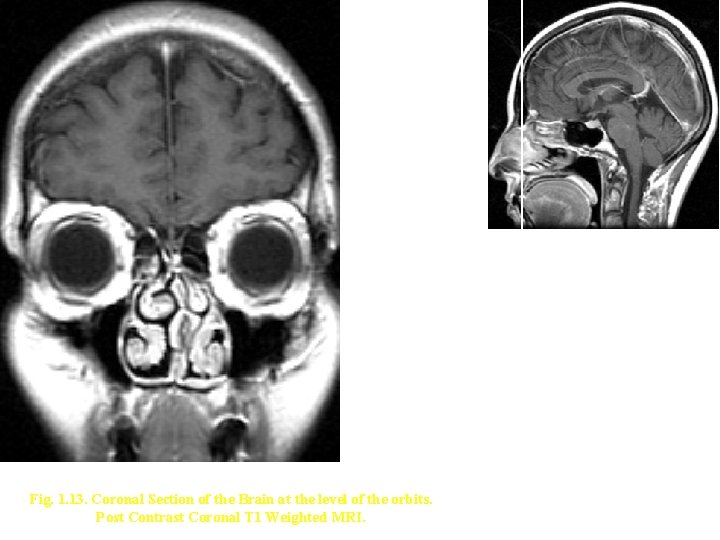 Fig. 1. 13. Coronal Section of the Brain at the level of the orbits.