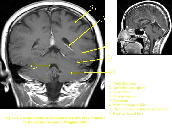 8 7 6 3 5 2 4 1 1. Cerebellar tonsil 2. Cerebellar hemisphere