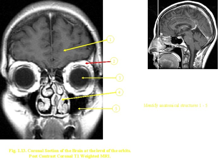 1 2 3 4 5 Fig. 1. 13. Coronal Section of the Brain at