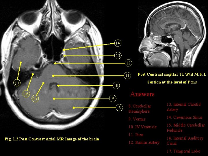 14 13 12 11 17 Post Contrast sagittal T 1 Wtd M. R. I.