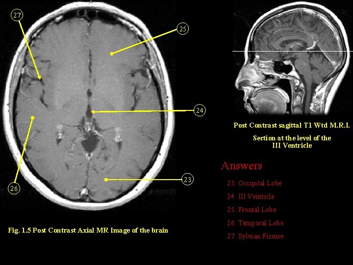 27 25 24 Post Contrast sagittal T 1 Wtd M. R. I. Section at