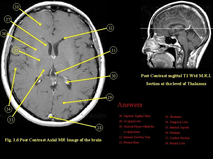 38 37 32 36 31 35 Post Contrast sagittal T 1 Wtd M. R.