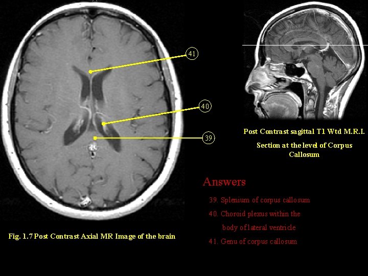 41 40 39 Post Contrast sagittal T 1 Wtd M. R. I. Section at