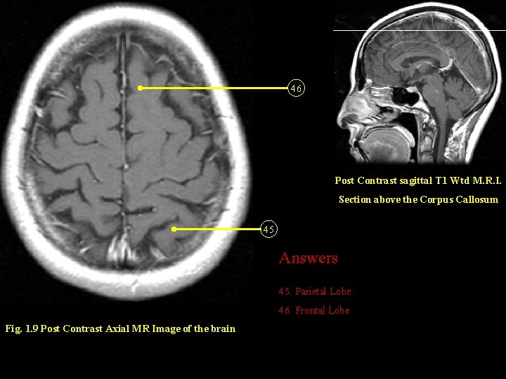 46 Post Contrast sagittal T 1 Wtd M. R. I. Section above the Corpus