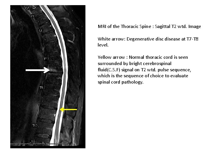 MRI of the Thoracic Spine : Sagittal T 2 wtd. Image White arrow: Degenerative