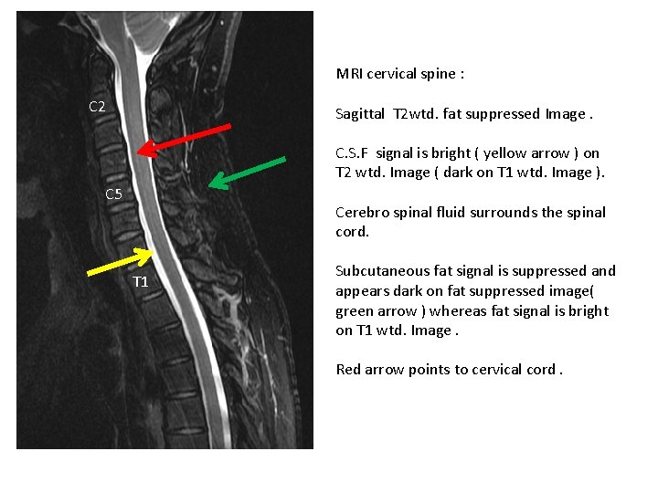 MRI cervical spine : C 2 Sagittal T 2 wtd. fat suppressed Image. C.